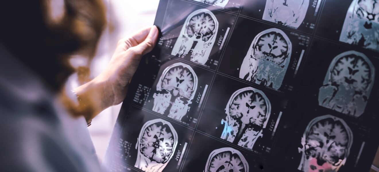 A physician surveying brain atrophy on MRI of Dementia patient.