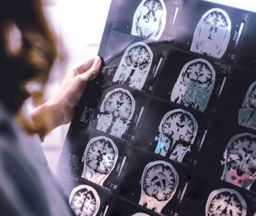 A physician surveying brain atrophy on MRI of Dementia patient.